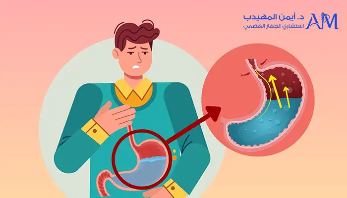 أعراض ارتجاع المريء الحاد