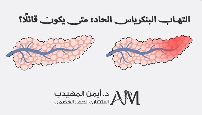 التهاب البنكرياس الحاد: متى يكون قاتلًا؟