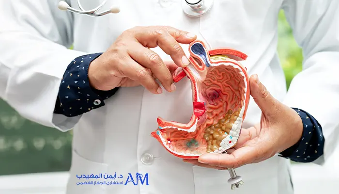 أعراض سرطان المعدة المبكرة التي يغفلها الكثير