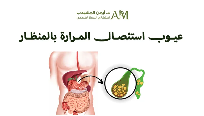 عيوب استئصال المرارة بالمنظار
