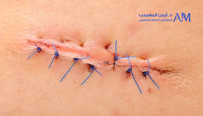 مدة عملية استئصال المرارة بالمنظار دكتور أيمن